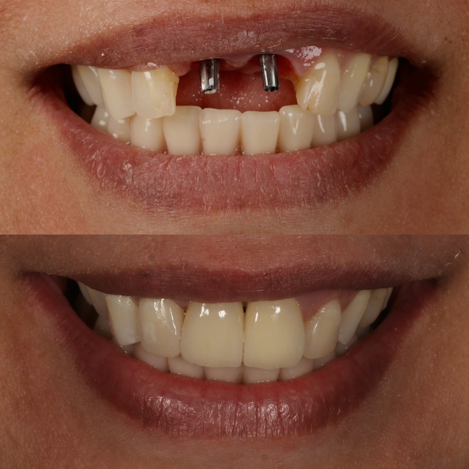 Implante dental - clínica